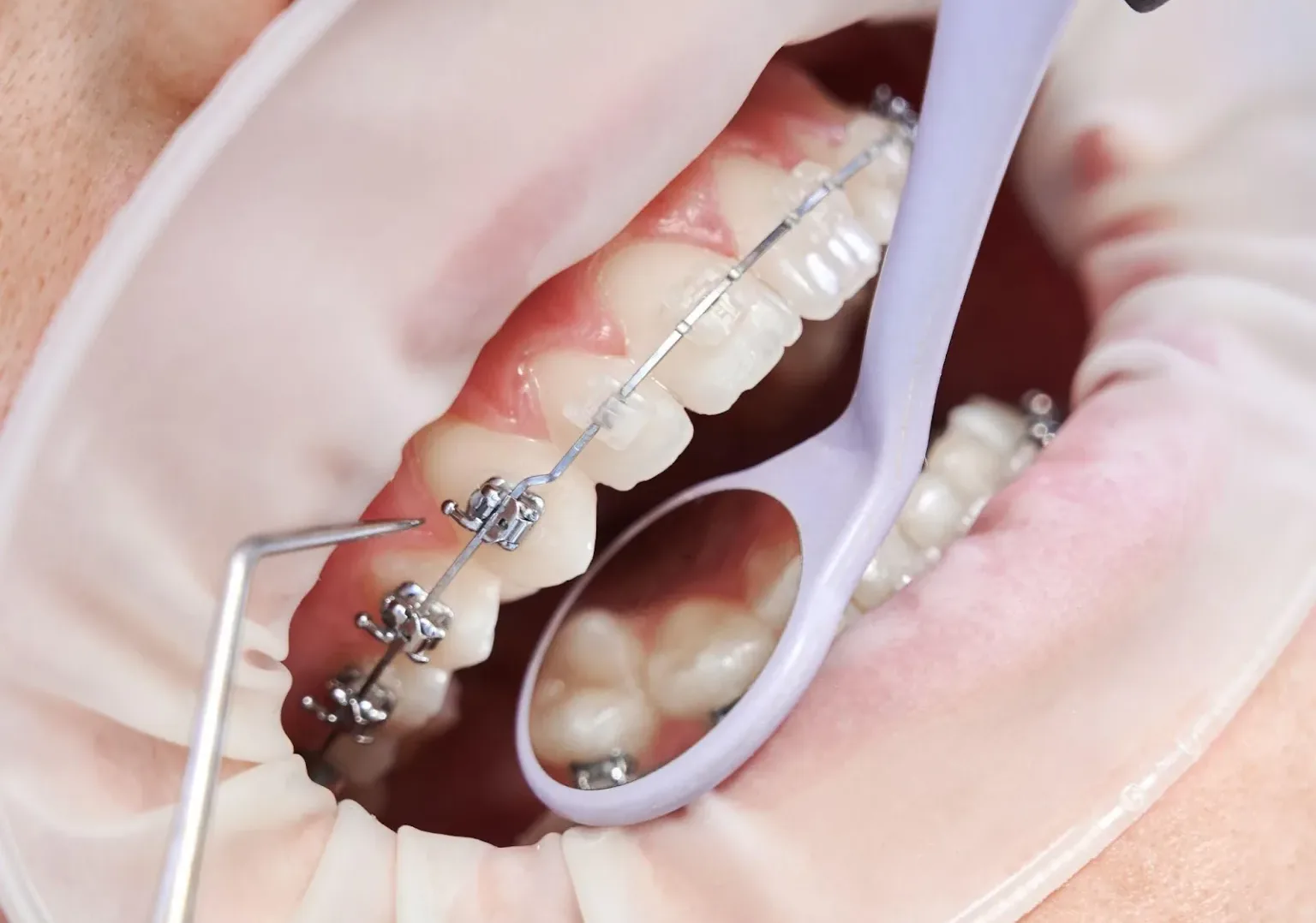 Ортодонтия для взрослых: стоит ли исправлять прикус?